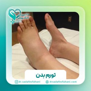 تورم بدن
