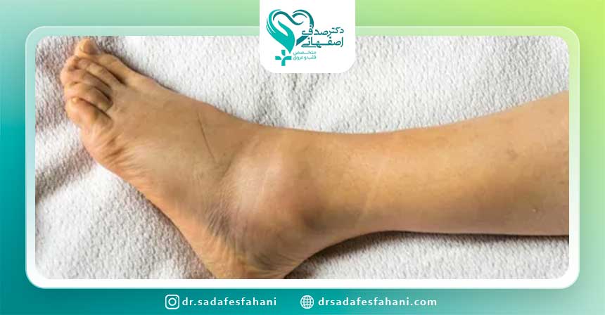 علائم ورم پا