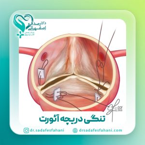 تنگی دریچه آئورت