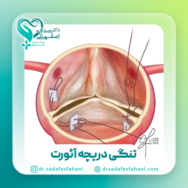 تنگی دریچه آئورت