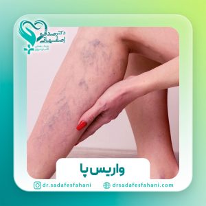 واریس پا