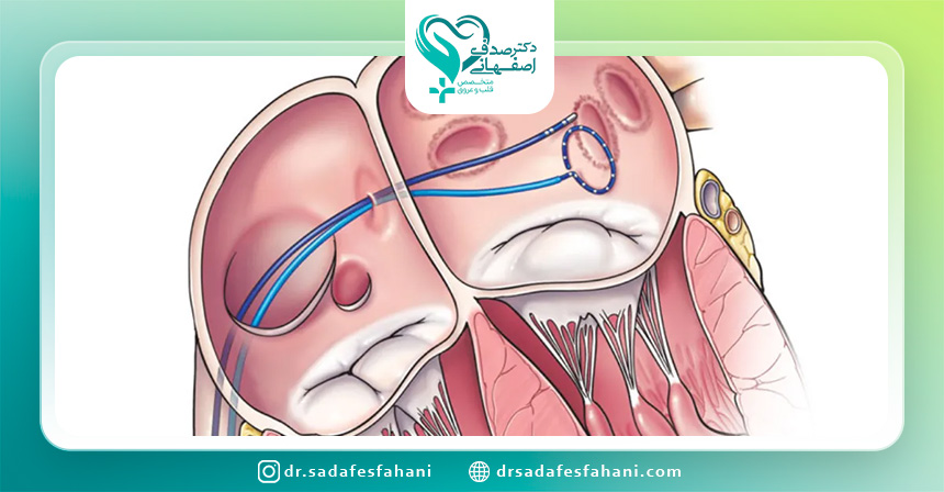 آیا تنگی دریچه آئورت به وسیله عمل جراحی قلب باز رفع میشود؟