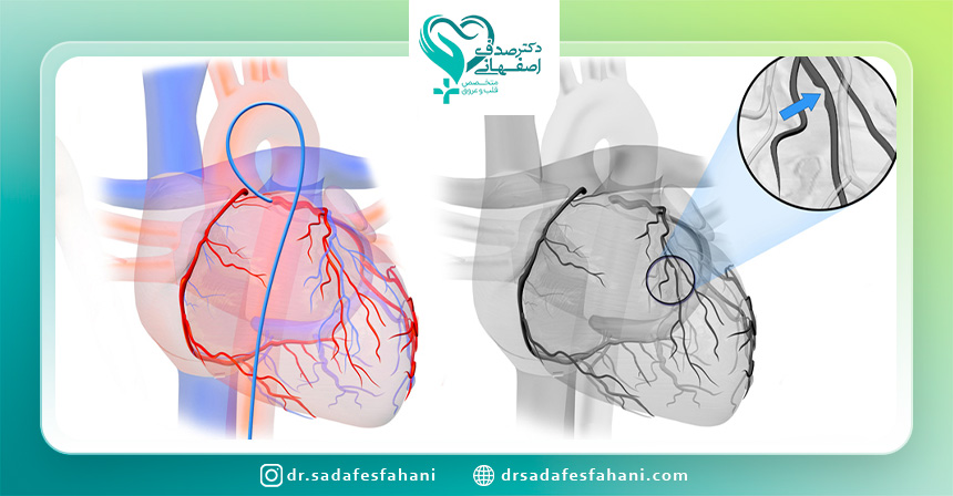 چه کسانی نباید آنژیوگرافی انجام دهند؟