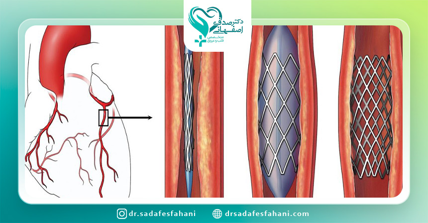 خطرات آنژیوگرافی