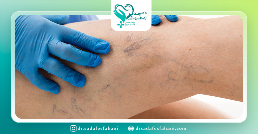 تشخیص واریس چگونه انجام می شود؟