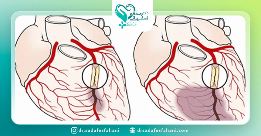مراقبت بعد از آنژیوگرافی قلب چیست؟