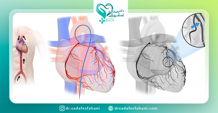 آنژیوگرافی قلب از طریق پا چگونه انجام میشود؟