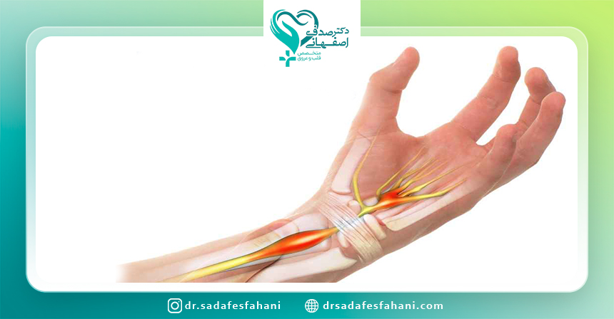 علل سندرم تونل کارپال