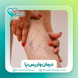درمان واریس پا