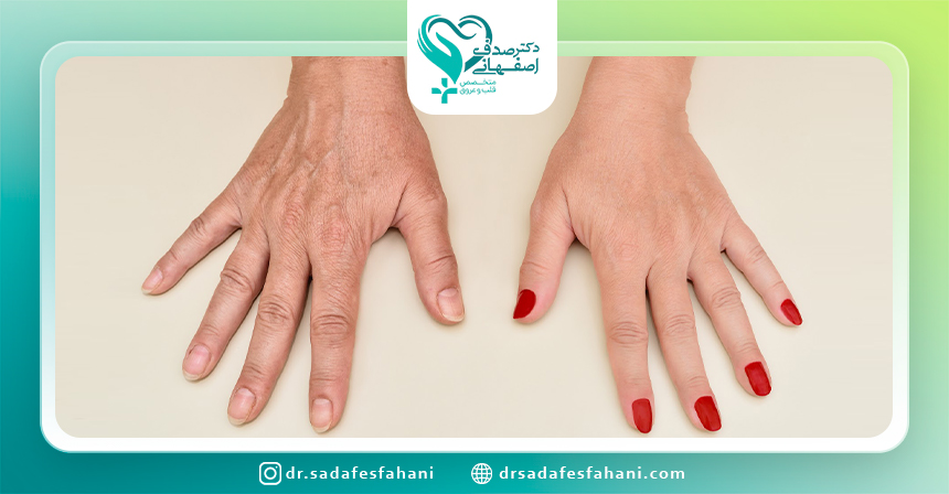 انواع واریس در نقاط بدن