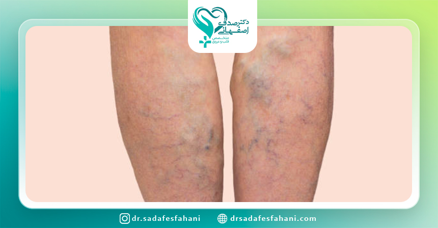علائم واریس