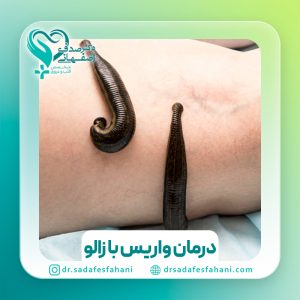 درمان واریس با زالو