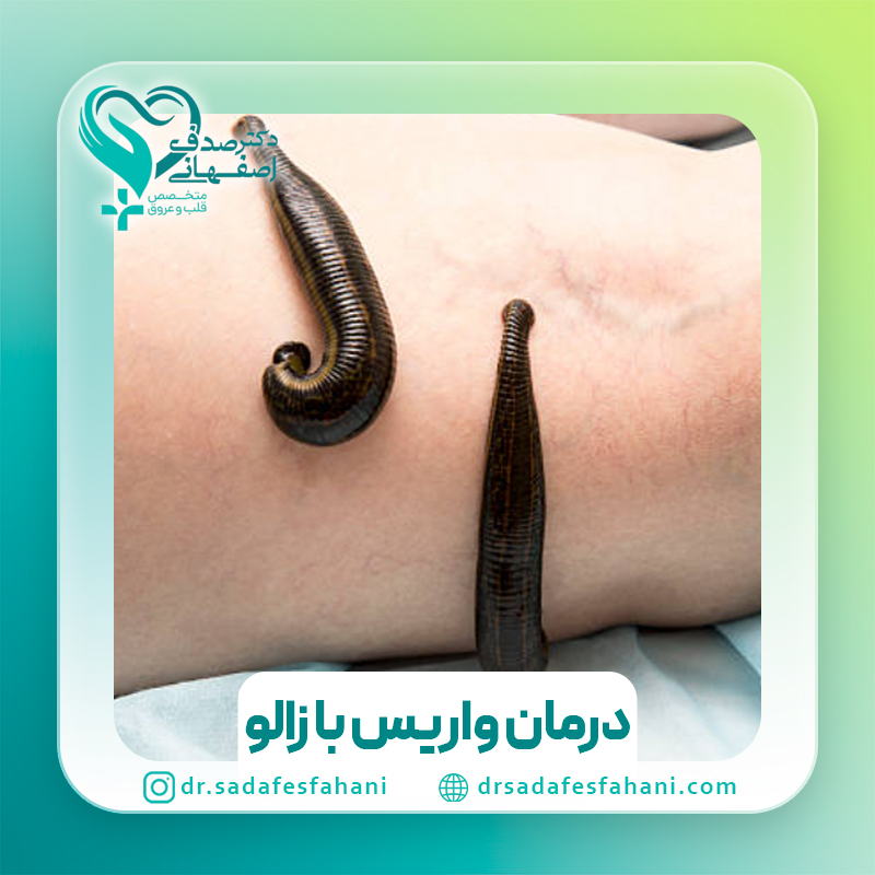 درمان واریس با زالو