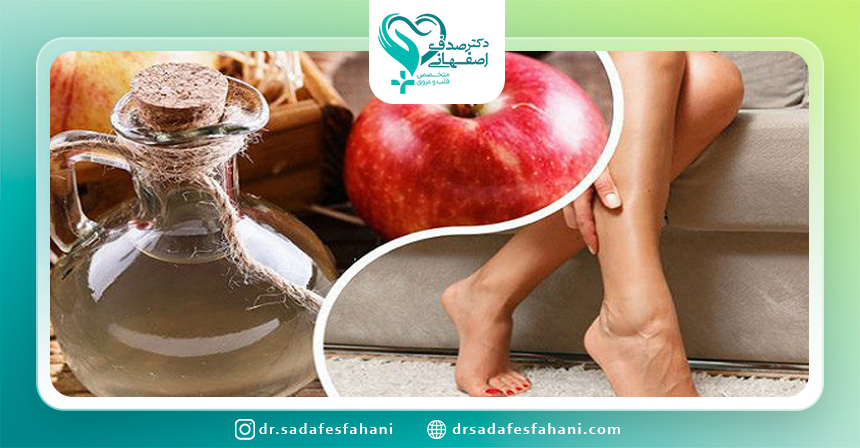 طریقه استفاده از سرکه سیب برای واریس