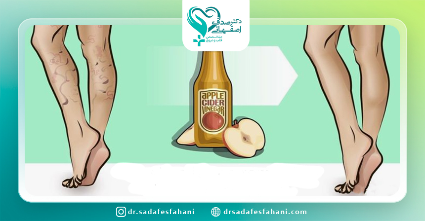 واریس و سرکه سیب