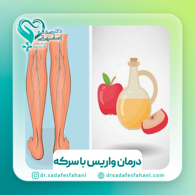 درمان واریس با سرکه سیب