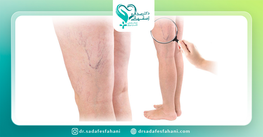 انواع واریس
