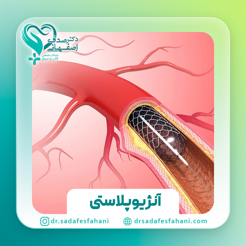 آنژیوپلاستی